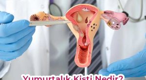 Yumurtalık Kisti Tedavisi: Kapsamlı Rehber ve Güncel Yaklaşımlar