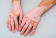 Nişantaşı’nda Excimer Lazer ile Vitiligo Tedavisi