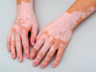 Nişantaşı’nda Excimer Lazer ile Vitiligo Tedavisi