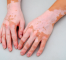 Nişantaşı’nda Excimer Lazer ile Vitiligo Tedavisi