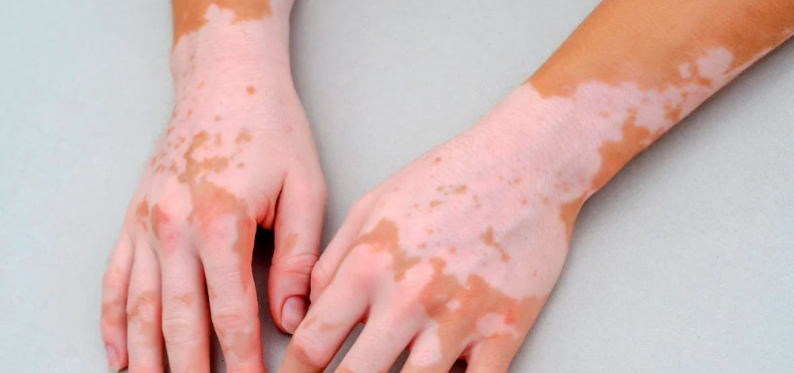 Nişantaşı’nda Excimer Lazer ile Vitiligo Tedavisi